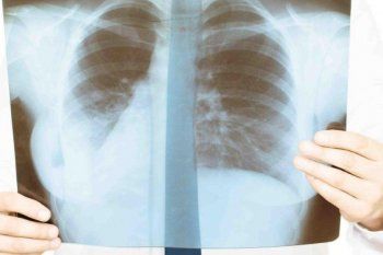 El 70% de los casos de cáncer de pulmón se detecta en etapa avanzada