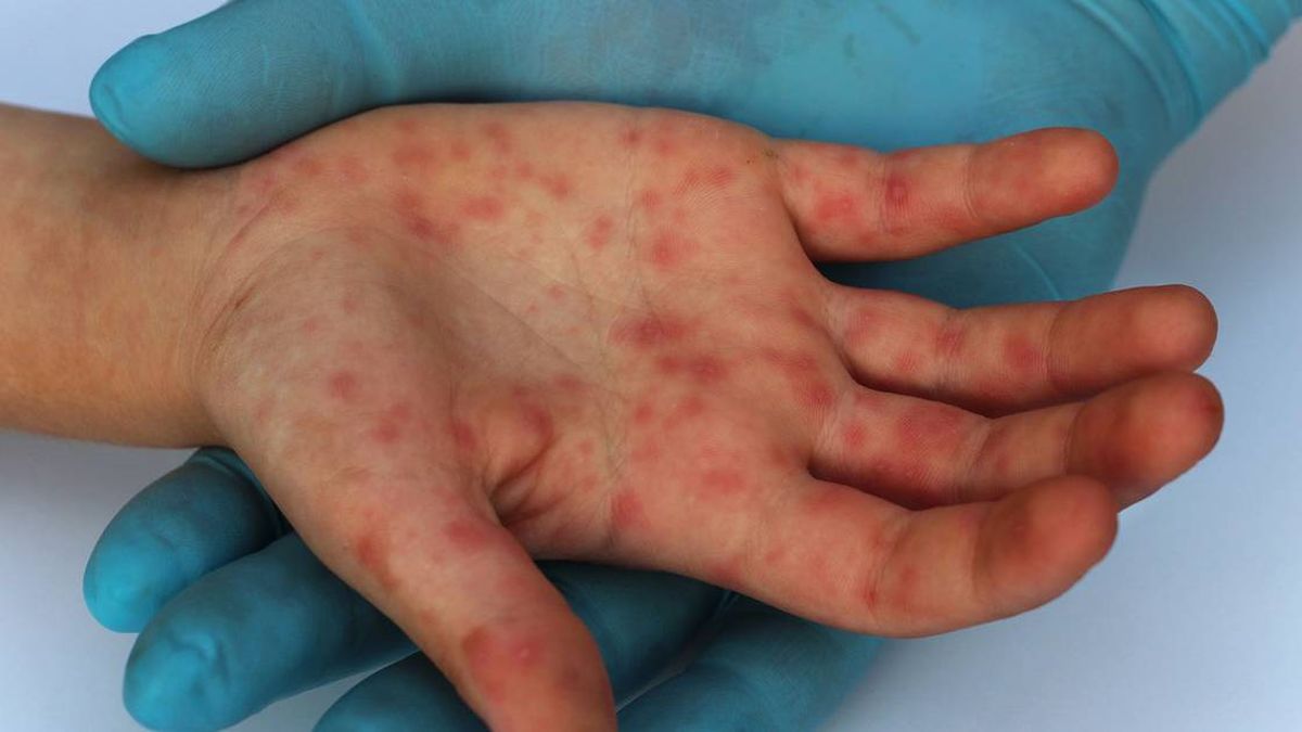 Monkeypox: What to do if symptoms appear?