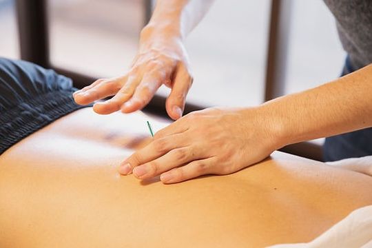 Qué es la acupuntura, la técnica milenaria que utilizan cada vez más los kinesiólogos.