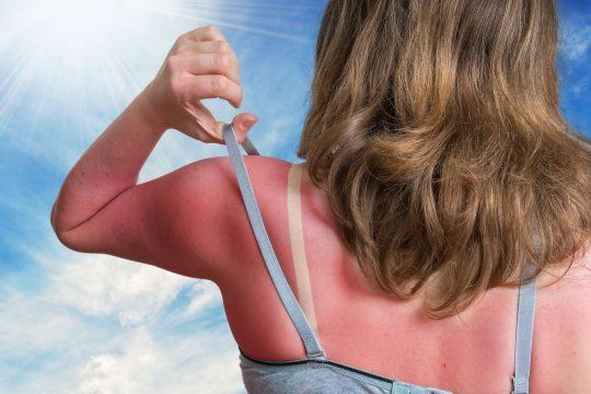 La exposición al sol sin protección y en algunos horarios puede ser muy peligrosa para la piel.