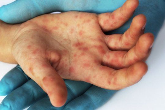 alerta epidemiologico por sarampion: como prevenir el contagio de la enfermedad