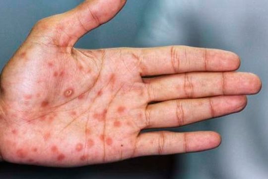 Viruela símica: Salud confirmó el quinto caso en el país.
