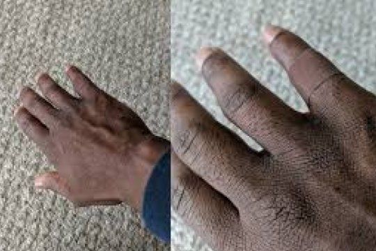 ?color piel?: la emocion de un hombre de tez negra al encontrar una curita con su tono de piel