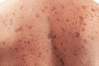 llega el calor, el sol y el riesgo de siempre: como detectar y prevenir un cancer de piel