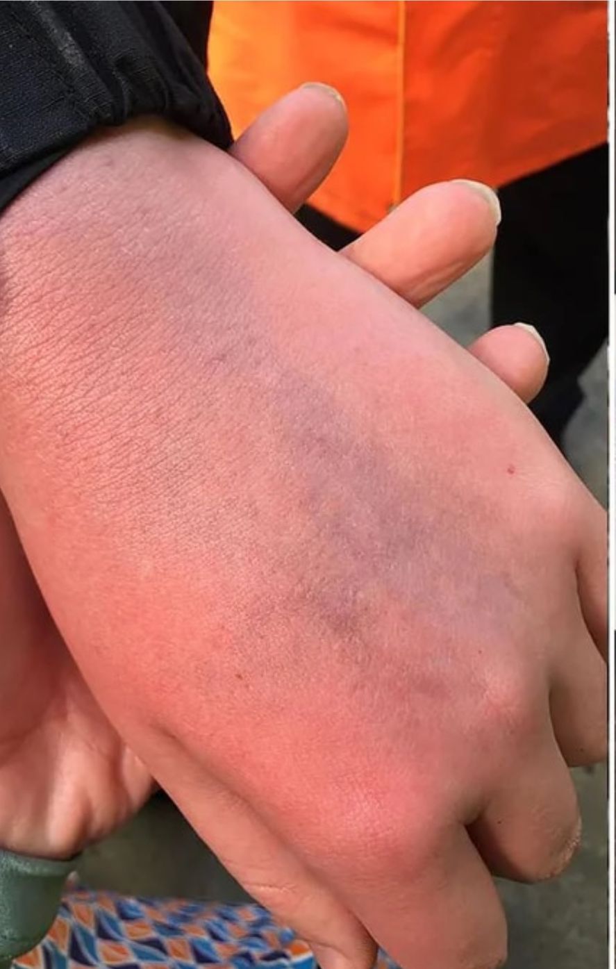 El evidente moretón en la mano del niño autista agredido por Cristiano Ronaldo 